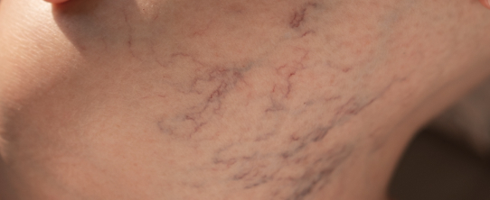 a photo of varicose veins on a person's abdomen