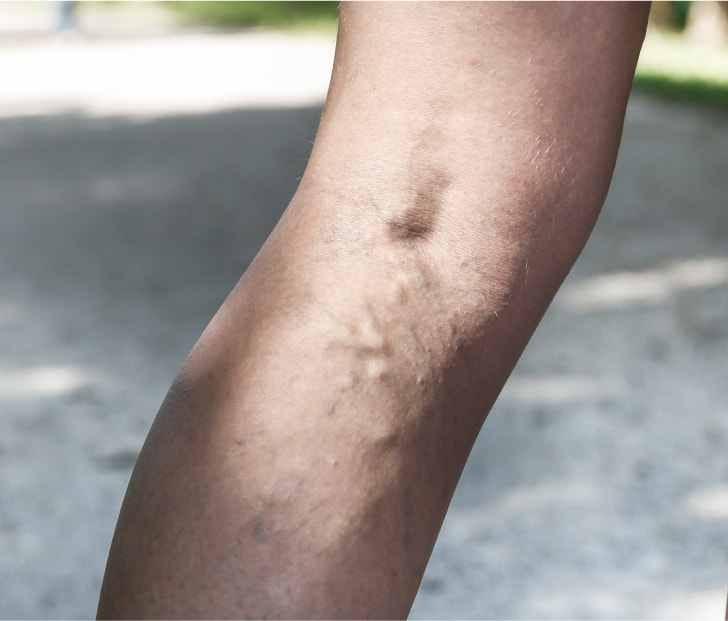 a photo of varicose veins in the upper calf