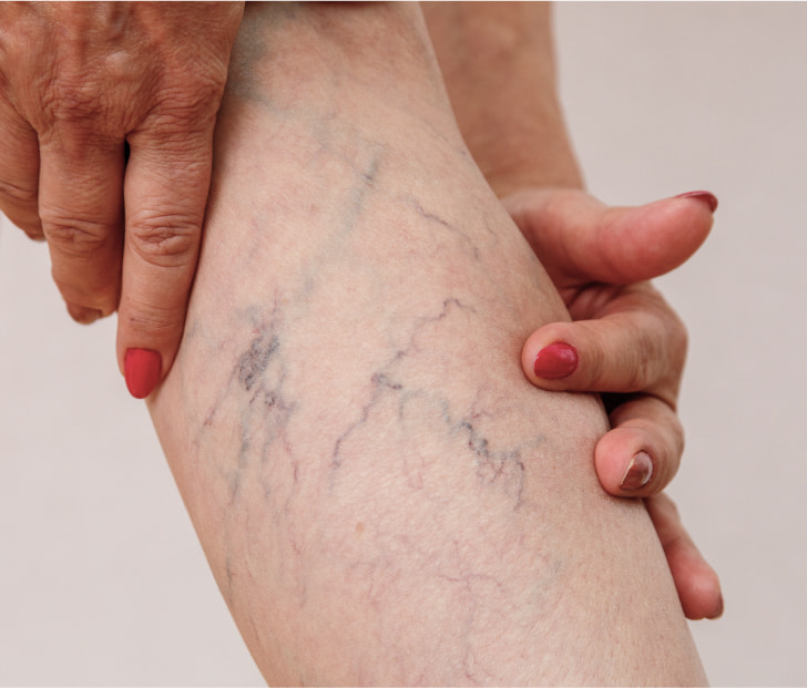 a photo of varicose veins in the calf