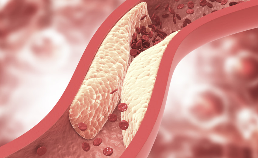 a computer generated image showing plaque accumulation in an artery (atherosclerosis)